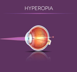 Hyperopia